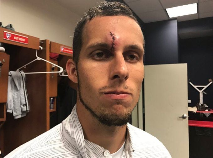 Matt Hedges after receiving post game stitches for a gash on his forehead vs NYCFC. (May 14, 2017)