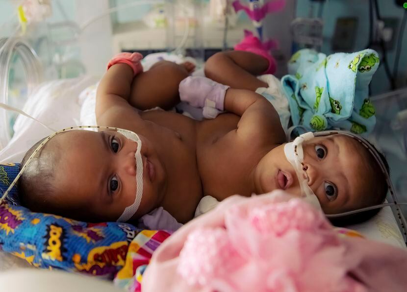 Conjoined twins JamieLynn and AmieLynn Finley ahead of a surgery to separate the girls. The...