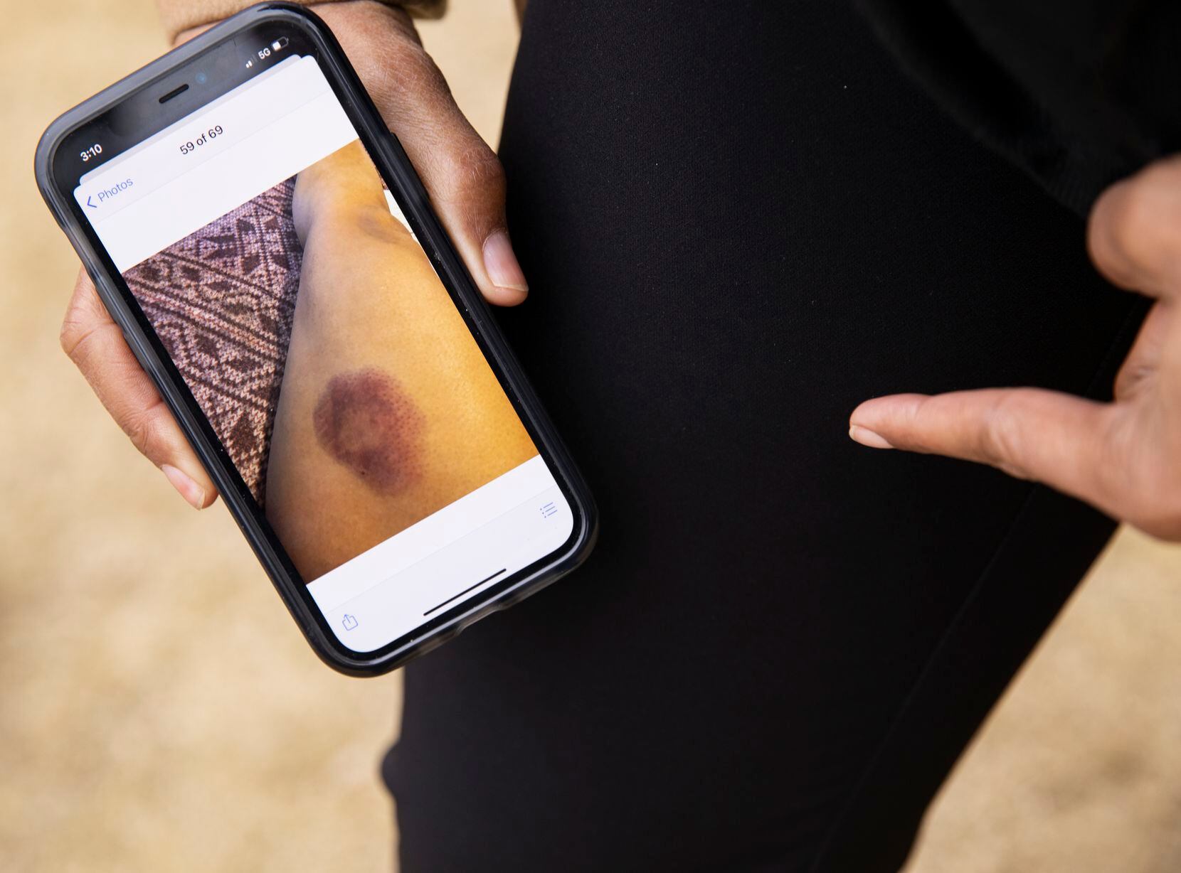 Shenita Cleveland shows a photo of the bruise left by a less than lethal round on her thigh May 31 at Pacific Plaza in Dallas.