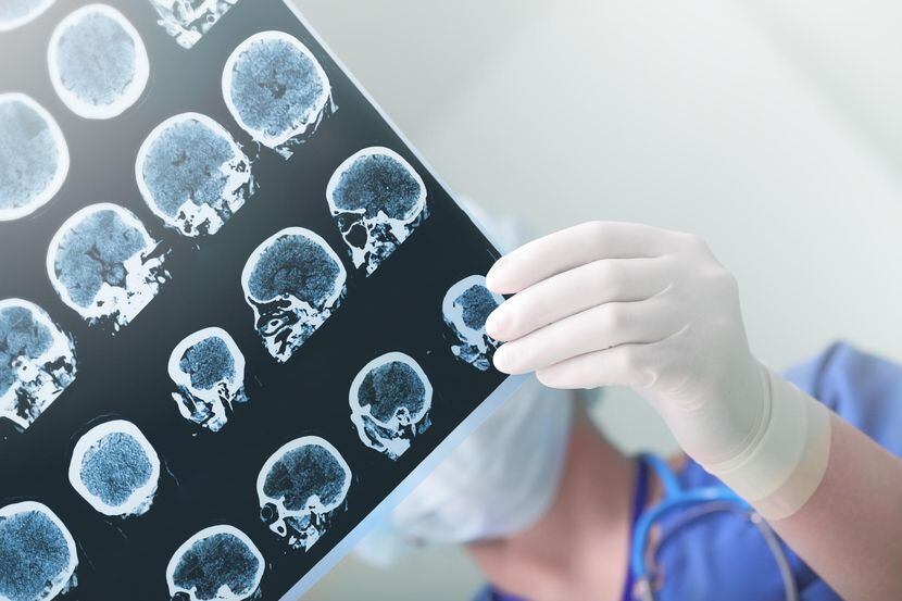 Un médico revisa una placa del cerebro de un paciente.(iStock)
