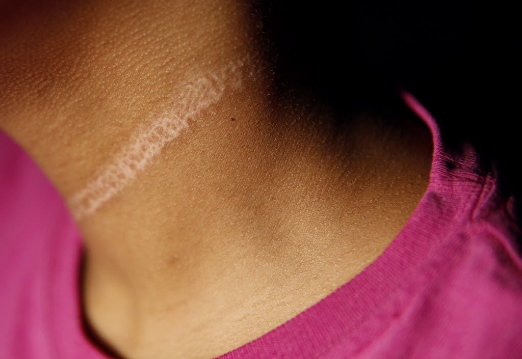 Detail of a former Live Oak Classical School student's scar from a 6th grade camping trip is...