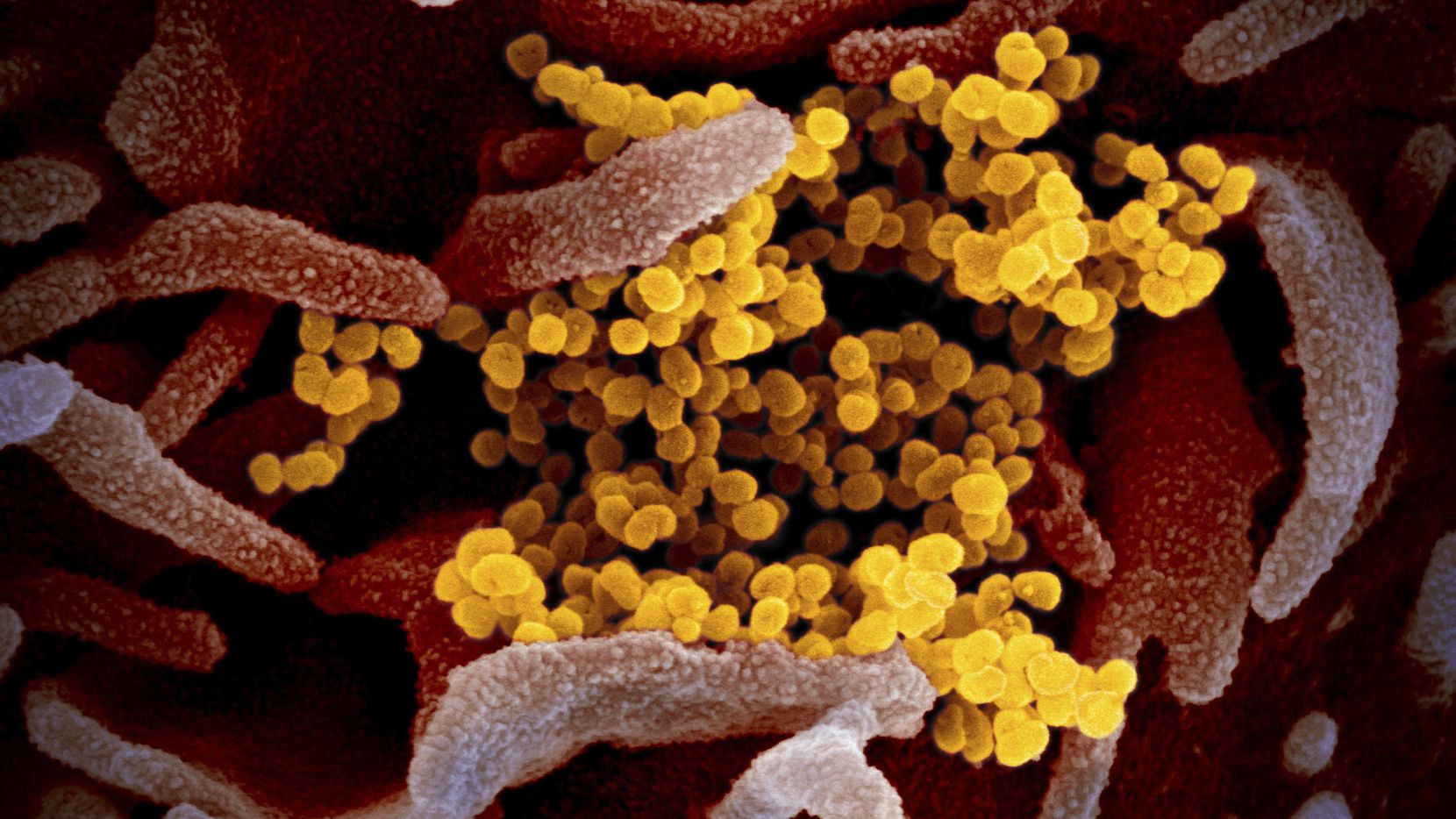 This undated electron microscope image made available by the U.S. National Institutes of Health in February 2020 shows the Novel Coronavirus SARS-CoV-2, yellow, emerging from the surface of cells, pink, cultured in the lab. Also known as 2019-nCoV, the virus causes COVID-19.