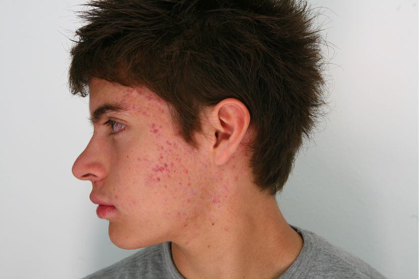 Los parches no se recomiendan para personas con acné moderado o grave.