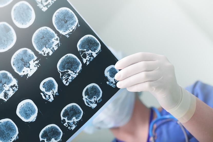 Un técnico médico examina una tomografía del cerebro de un paciente. GETTY IMAGES.
