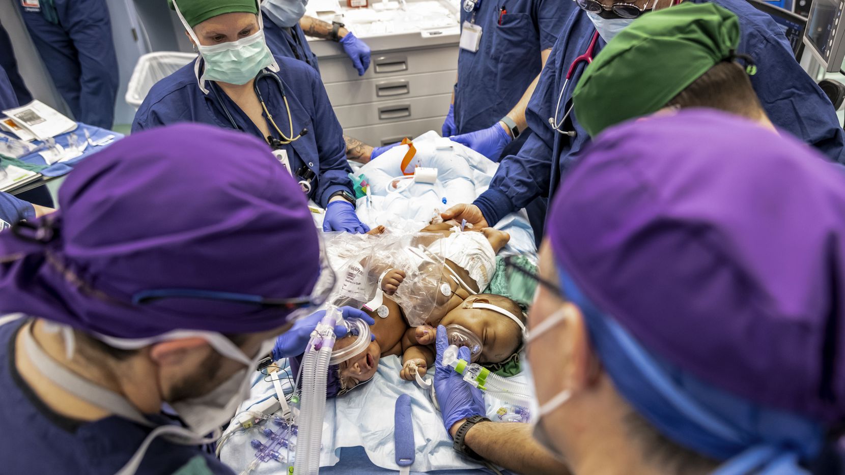 A team of medical professionals operate on conjoined twins JamieLynn and AmieLynn at Cook...