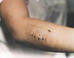  A photo of the stab wound to Routier's arm in 1996.