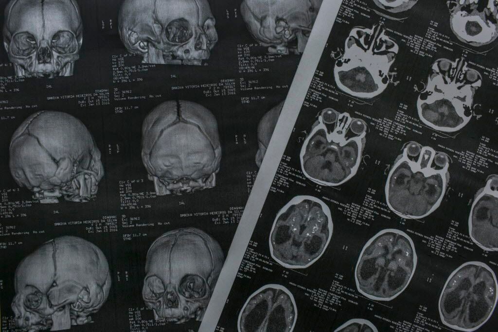 A tomography result of a three-month girl with microcephaly lies on a doctor's office at the...