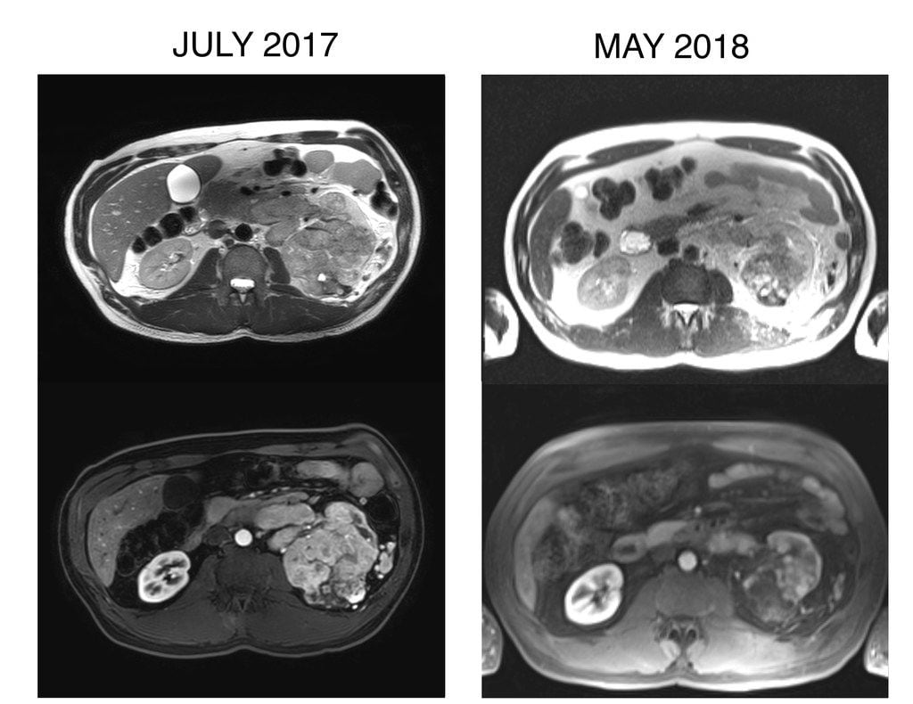 Above are two views of my left kidney, which, if this makes any sense at all, is the mass on the right-hand side of these scans. The July 2017 scan shows a kidney that's essentially one large tumor. Almost a year later, after the RADVAX trial, the tumor began to shrink, revealing some normal kidney tissue. I no longer have that kidney.