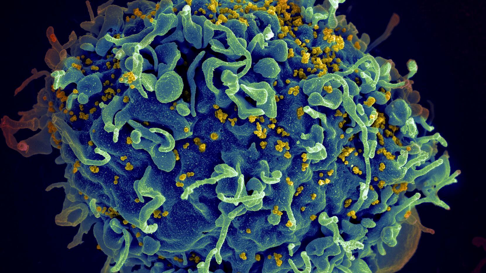 This electron microscope image shows a human T cell, in blue, under attack by HIV, in...