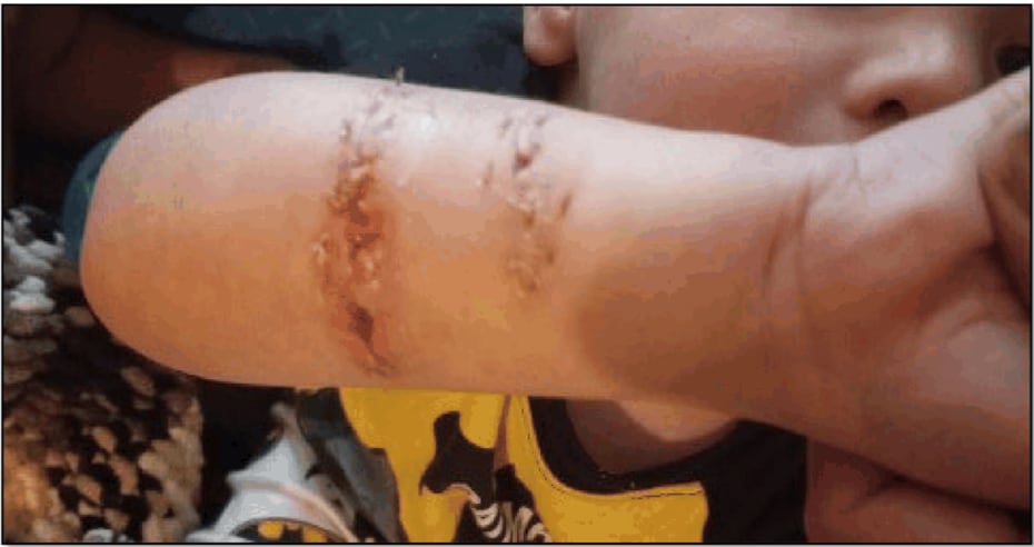 The lawsuit included pictures of the scars left on Nathan Williams' arm.