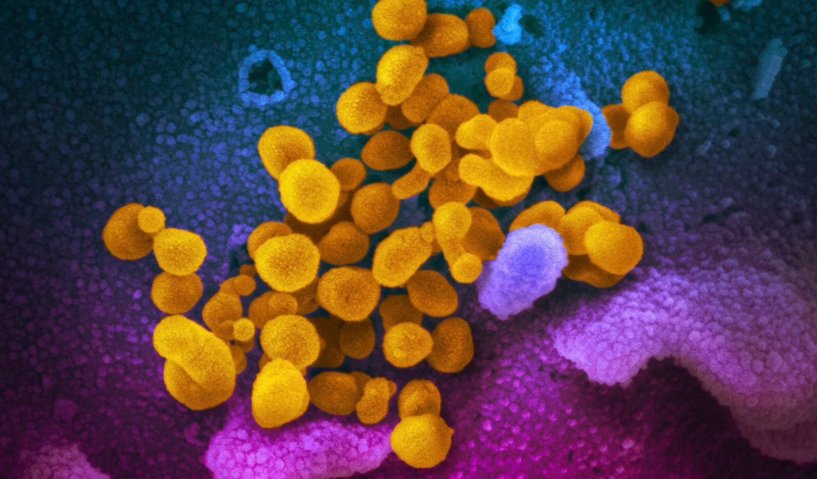 Células de coronavirus, indicadas en amarillo, saliendo de la superficie de células marcadas...