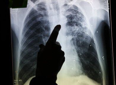 La tuberculosis se contagia por vía aérea, generalmente entre quienes tienen un contacto...