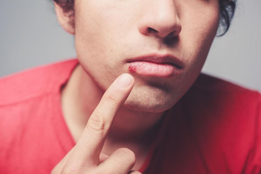 El herpes labial se manifiesta en forma de fuegos o ampollas en los labios.