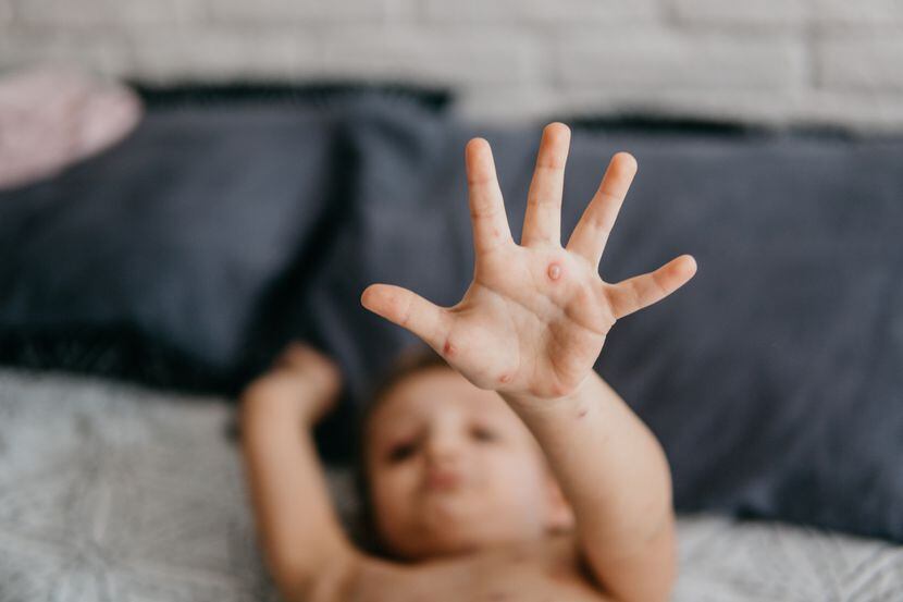 Una niña es atendida por haber presentado síntomas de sarampión. iSTOCK
