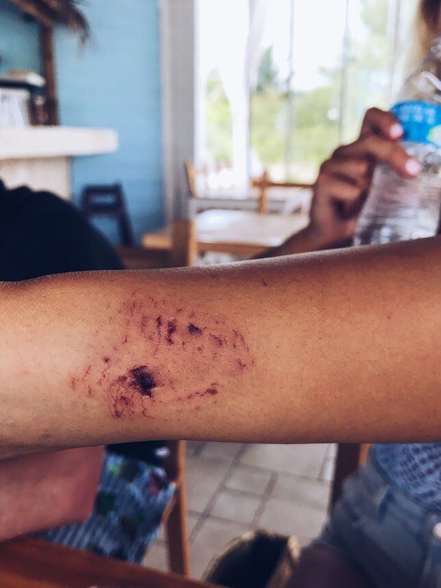 Katarina Zarutskie's bite wound.