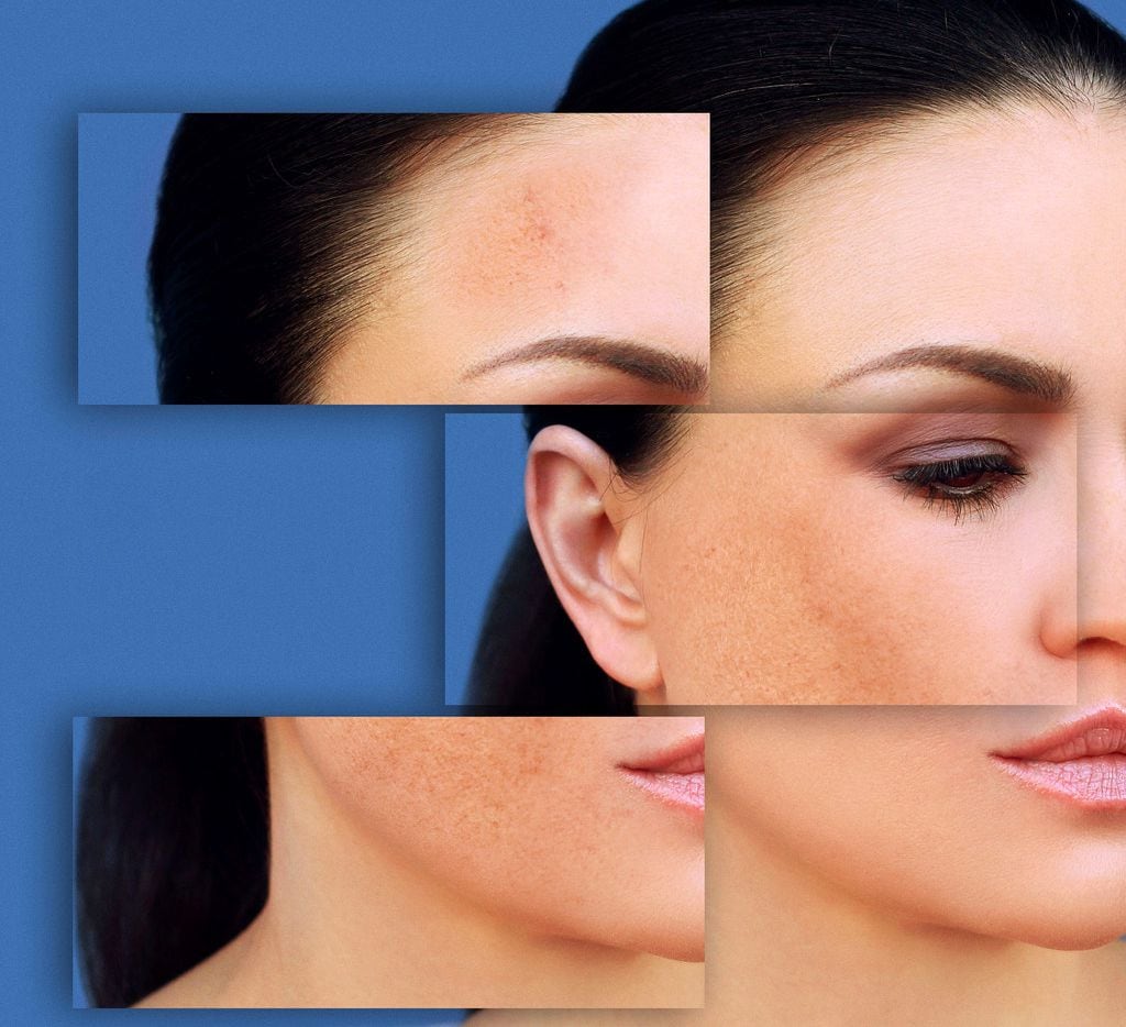 Dark spots, freckles, hyperpigmentation, skin condition (melasma or chloasma)