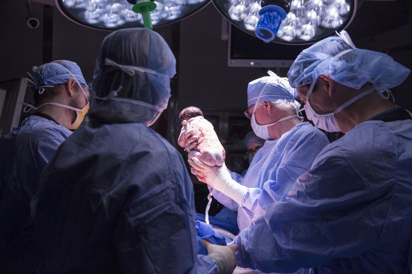 Los médicos de Baulor University Medical Center durante el parte de un bebé cuya madra nació...