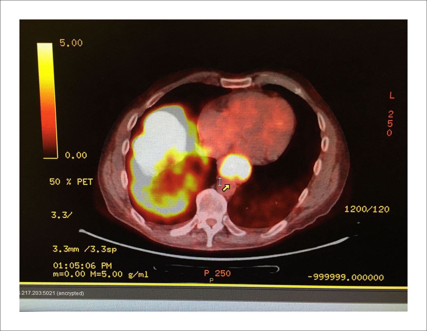 9/19/16 — This one had to be in color. PET scans show the heat profile of cells. Cancer cells grow faster and show more "heat" than normal. White hot is bad. The circle near the spinal cord is the tumor in my esophagus. The mass at left is my liver. The good news is the cancer isn't anywhere else. Chemo begins Thursday. Game on!