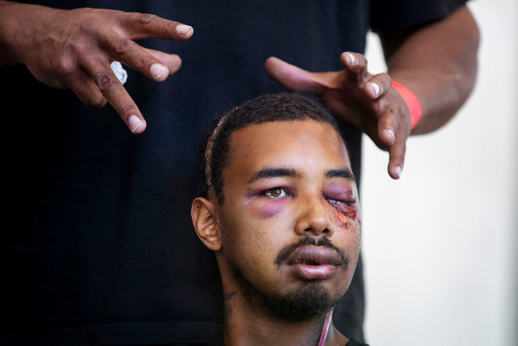 During a news conference June 3, 2020, Andre Ray showed the severe injuries sustained in the...