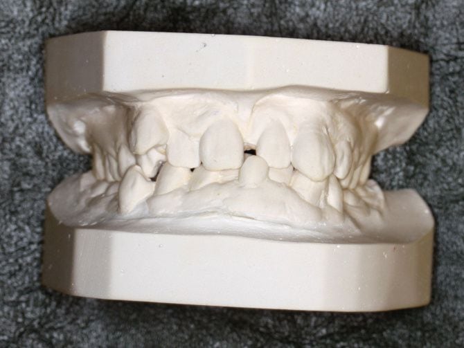 Casts taken of Robina Rayamajhi's teeth show the severe dental problems that have plagued...