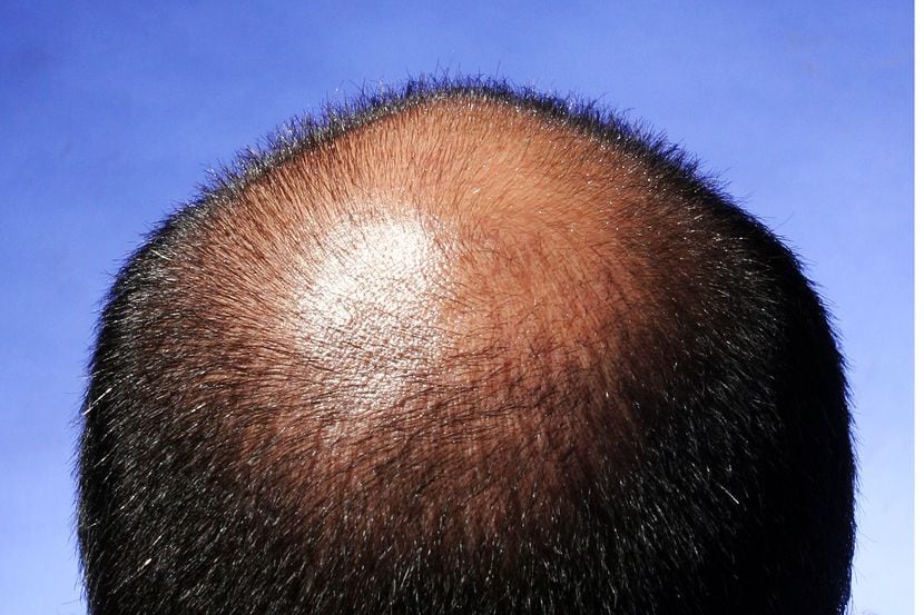 La alopecia afecta a personas de cualquier edad, en los niños es común que se deba a hongos...