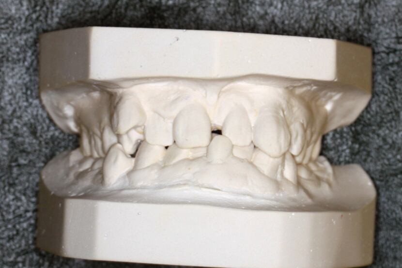 Casts taken of Robina Rayamajhi's teeth show the severe dental problems that have plagued...