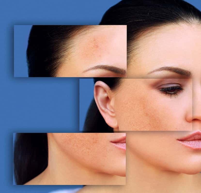 Melasma often appears on cheeks in a butterfly pattern, on the forehead and upper lip.