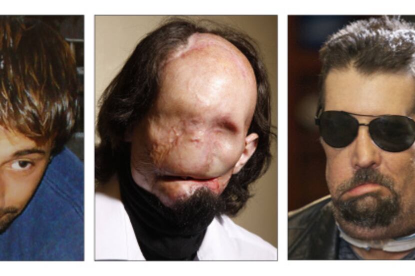 Dallas Wiens (left, in 2008) had been featureless from reconstructive surgeries prior to his...