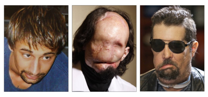 Dallas Wiens (left, in 2008) had been featureless from reconstructive surgeries prior to his...