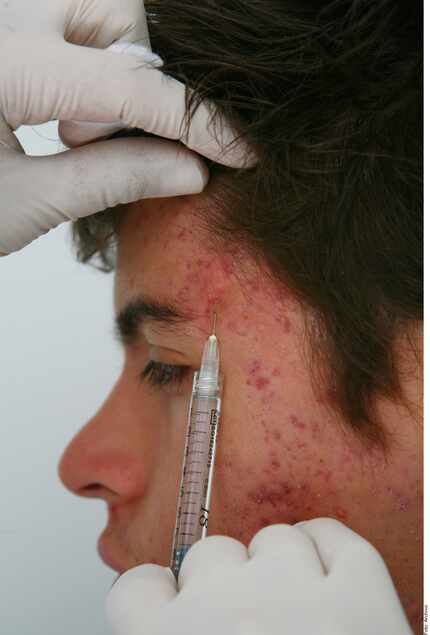 El acné es un padecimiento del complejo folículosebáceo, o sea, de la unidad compuesta por...