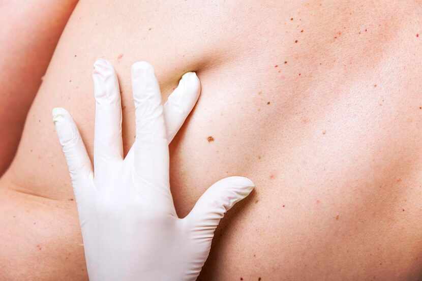 
Between 20 percent and 40 percent of melanomas develop from pre-existing moles, researchers...