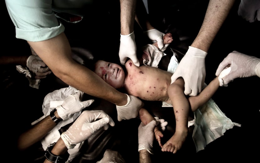 Palestinian medics treat a wounded girl at the emergency room of the Shifa hospital in Gaza...