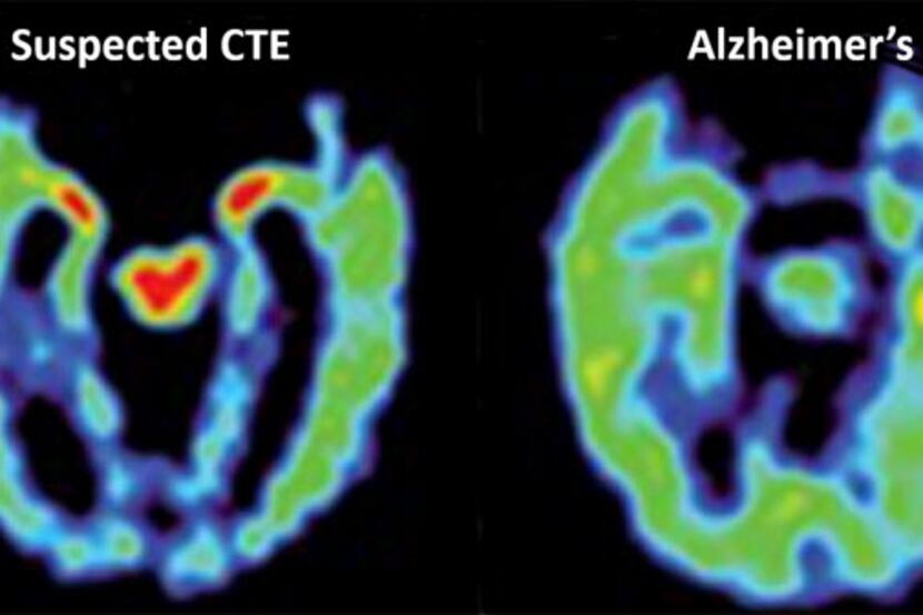 This combination of PET scans provided by UCLA on April 2, 2015 shows, from left, a normal...