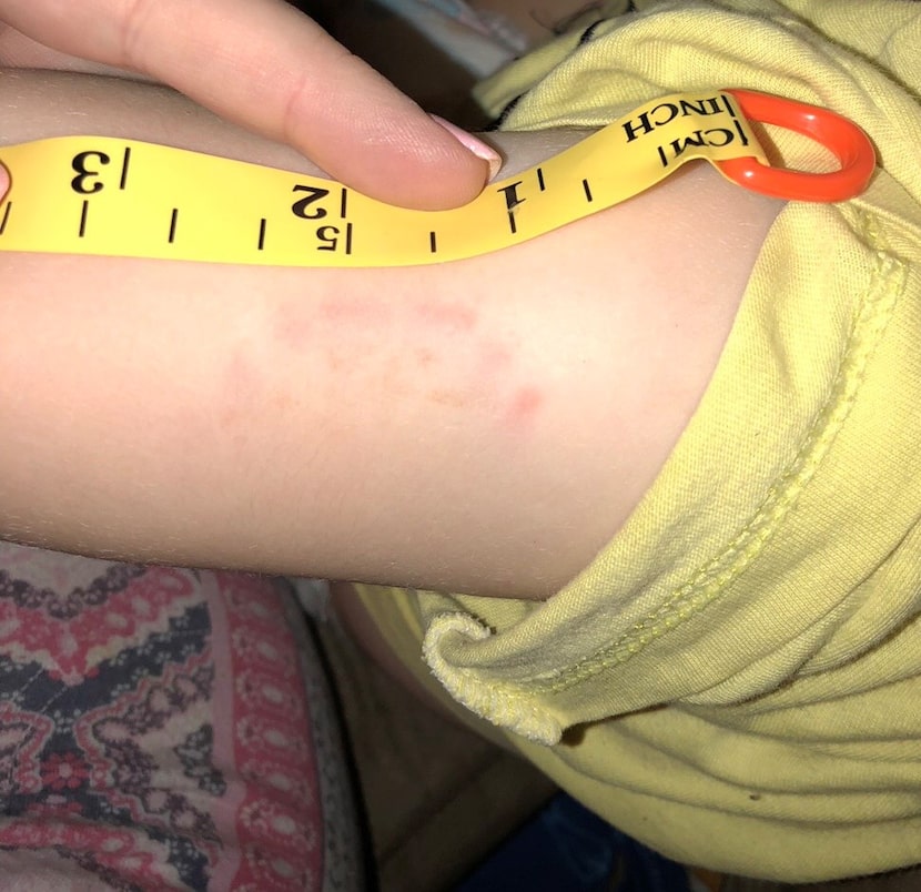 Audra Elliott photographed her daughter's arm the evening after her teacher at Twin Creeks...