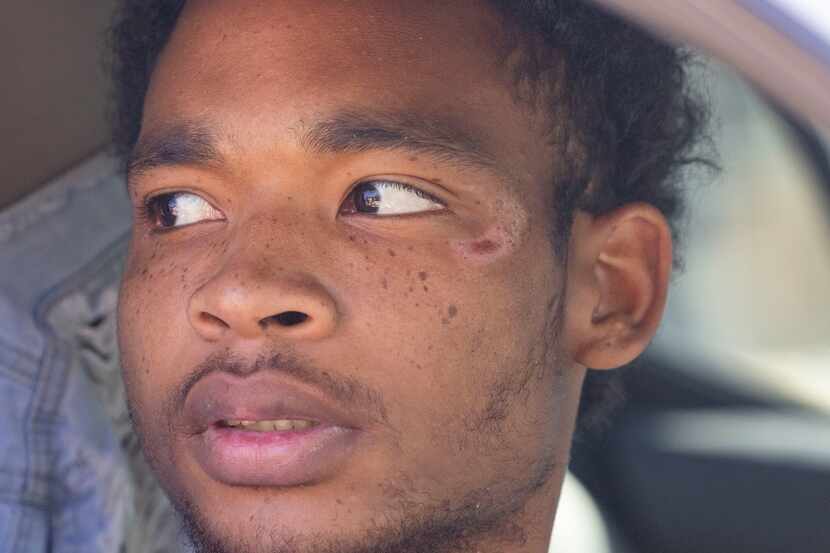 A scar can be seen on Keandre Green’s, 21, face as he talks to reporters after being...