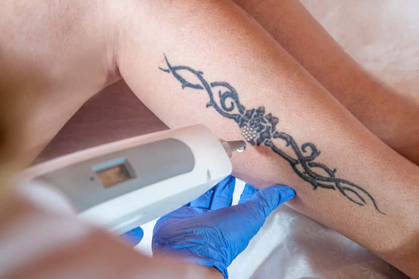 Le remoción de un tatuaje en la pierna de un paciente con una herramienta de rayo laser.