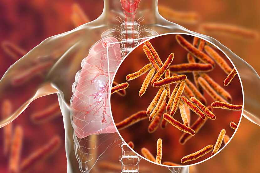 La Mycobacterium afecta más frecuentemente al pulmón, aunque puede afectar diferentes...