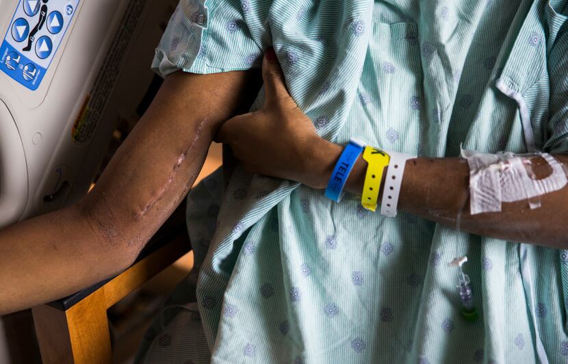 Daniela Calderon shows scars on her right arm from surgery in her North Texas hospital room...