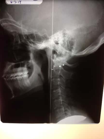 An X-ray of Jon's neck taken in June 2014. Neck problems can often be the cause of headaches...