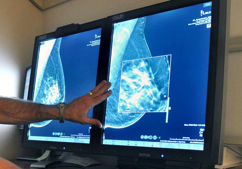 Un radiólogo compara tomas de mamografías. Un estudio reveló que el cáncer en su etapa...