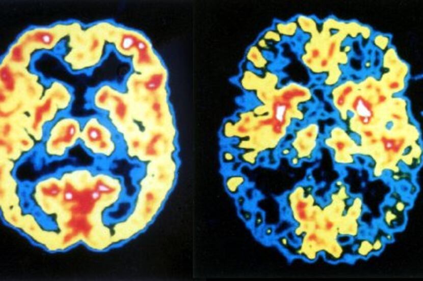A PET scan comparison shows a normal brain (left) and the effects of Alzheimer's (right). ...