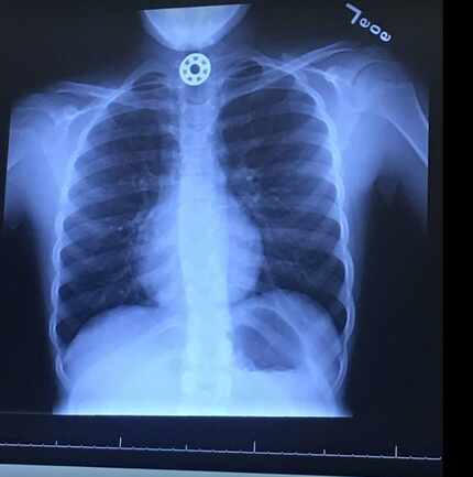 On Facebook, Joniec posted a photo of the X-ray showing the bushing lodged in her daughter's...