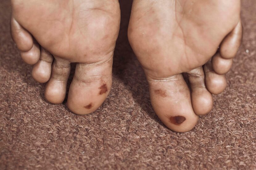 Abdoul, 32 year-old migrant from Maghama, Mauritania shows injuries on his feet from...