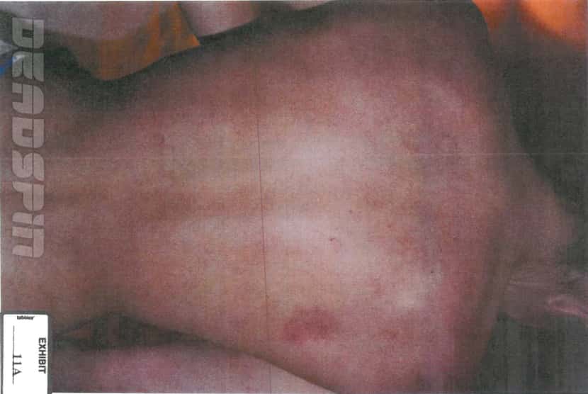 A photo showing the bruises to Nicole Holder's back. Deadspin.com