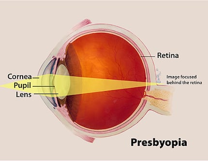 Presbyopia is often referred to as the aging eye condition.