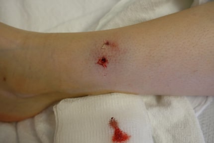 Puncture wounds to the ankle were among the severe bites London Pinder suffered when she was...