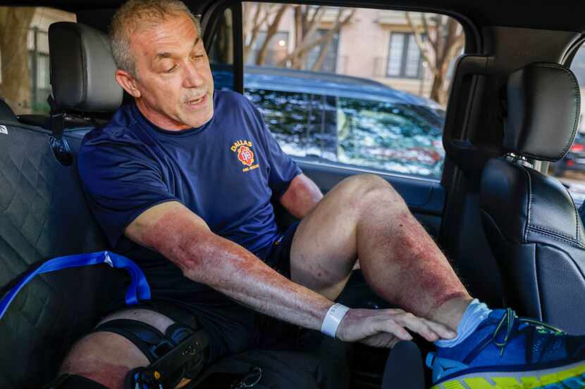 Dallas Fire-Rescue driver engineer Ronald W. Hall shows his burn scars while speaking with...