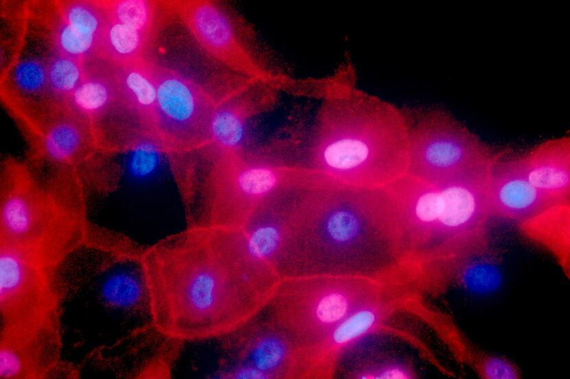 A fluorescence-colored microscope image shows a culture of human breast cancer cells. 