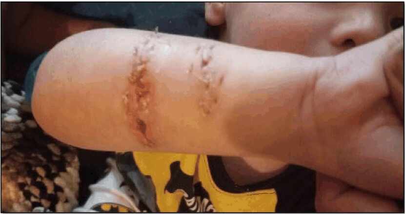 Nathan Williams tiene estas cicatrices debido al supuesto ataque de una nutria en el Dallas...