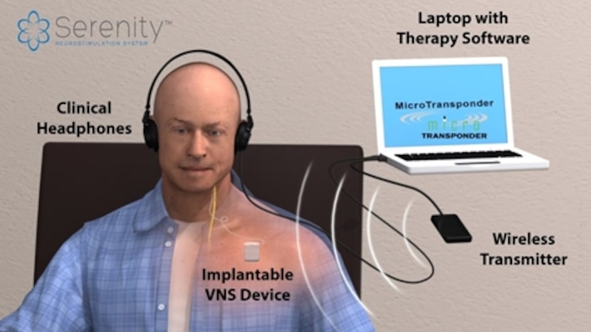 The treatment consists of coupling electrical impulses to stimulate the vagus nerve with...